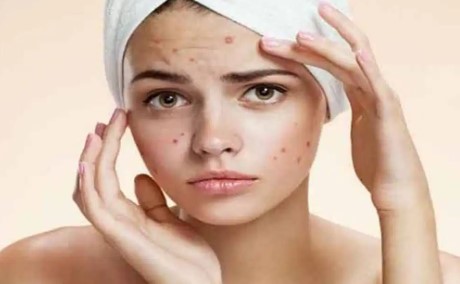 पीरियड्स से पहले और बाद में क्यों होते हैं फेस पर पिंपल्स? क्या है इसकी वजह