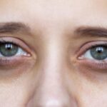 आंखों के काले घेरों से छुटकारा चाहते हैं? आजमाएं ये प्रभावी घरेलू नुस्खे