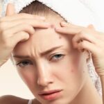 माथे पर होने वाले मुंहासों को हटाने के लिए अपनाएं ये 5 असरदार टिप्स