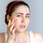 मानसून में नमी से होने लगे हैं मुंहासे? छुटकारा पाने के लिए अपनाएं ये नुस्खे