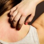 बरसात के मौसम में होती है एलर्जी, तो ऐसे करें बचाव