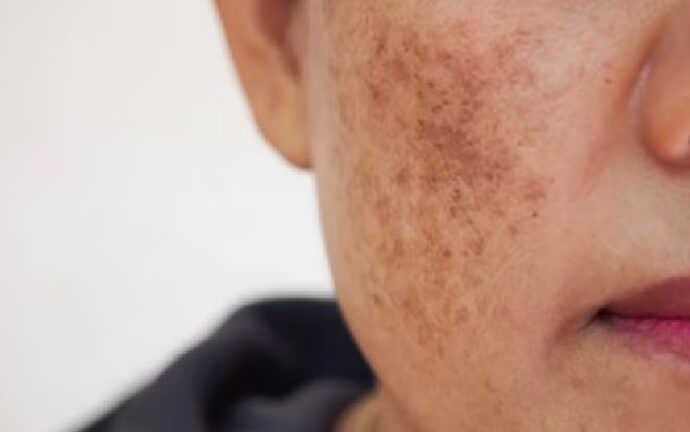 क्या आपके चेहरे पर भी हैं दाग-धब्बे, तो इन घरेलू नुस्खों की मदद से कर सकते हैं गायब